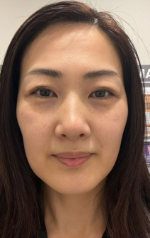 エラボトックス施術後