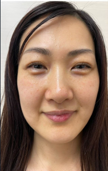 エラボトックス施術前