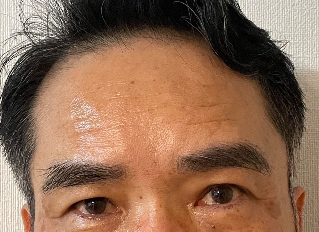 額ボトックス施術後