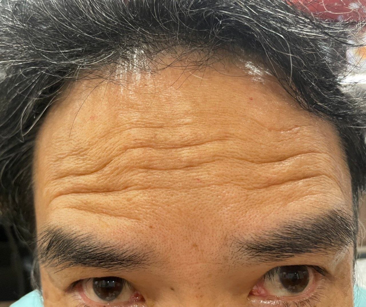 額ボトックス施術前