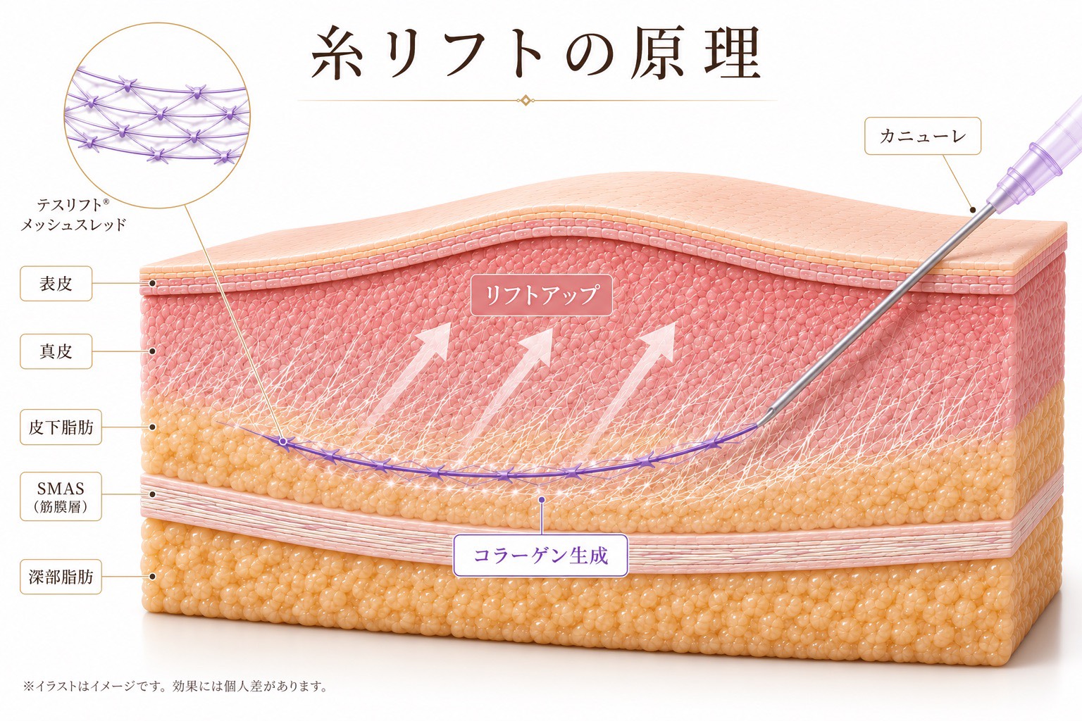 糸リフトとは