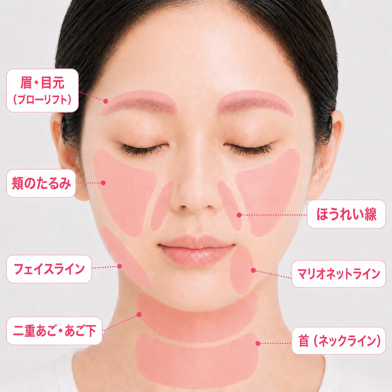 糸リフトの主な適応部位（女性）