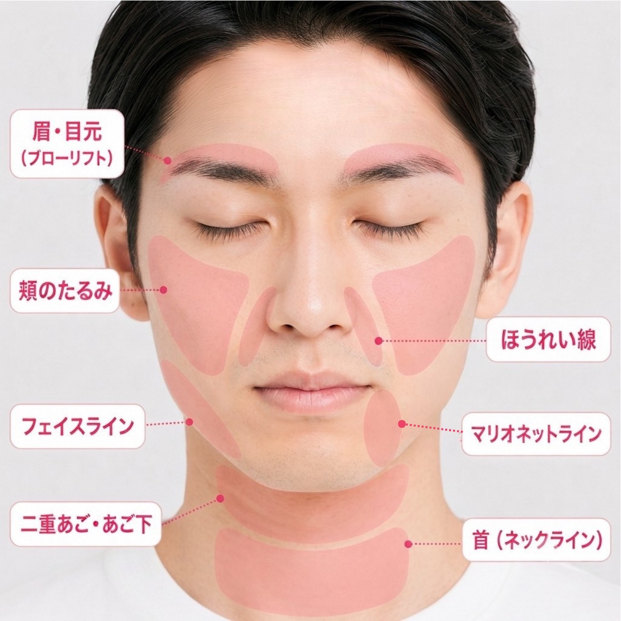 糸リフトの主な適応部位（男性）