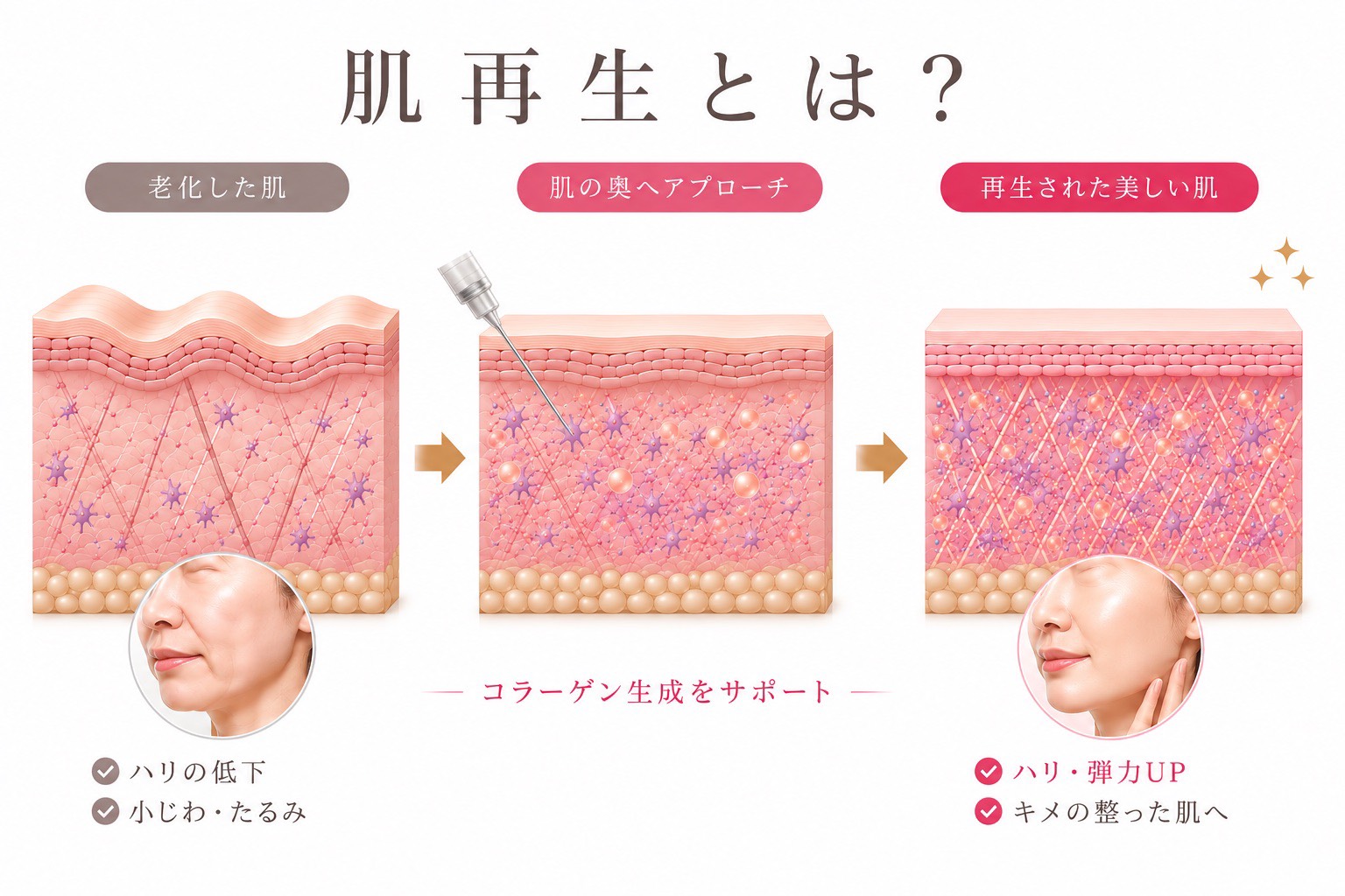 肌治療（肌再生・バイオリモデリング）とは